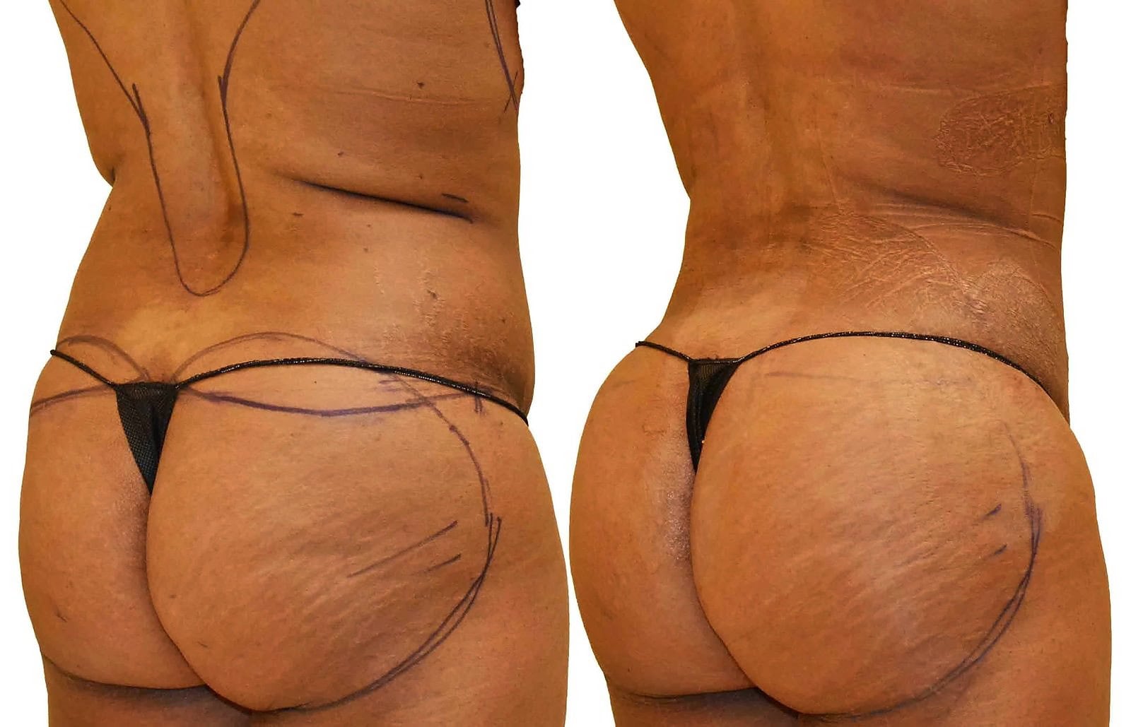 Fat Transfer, BBL before and after, actual patient of Dr. Long