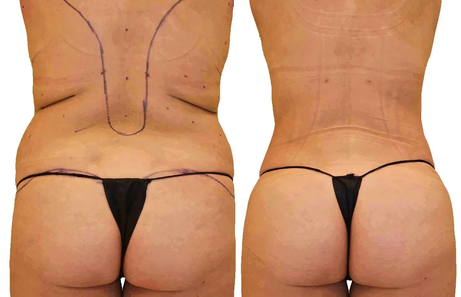 Fat Transfer, BBL before and after, actual patient of Dr. Long