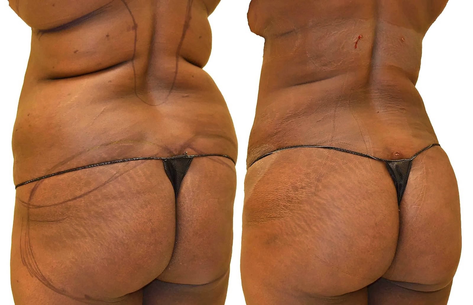 Fat Transfer, BBL before and after, actual patient of Dr. Long