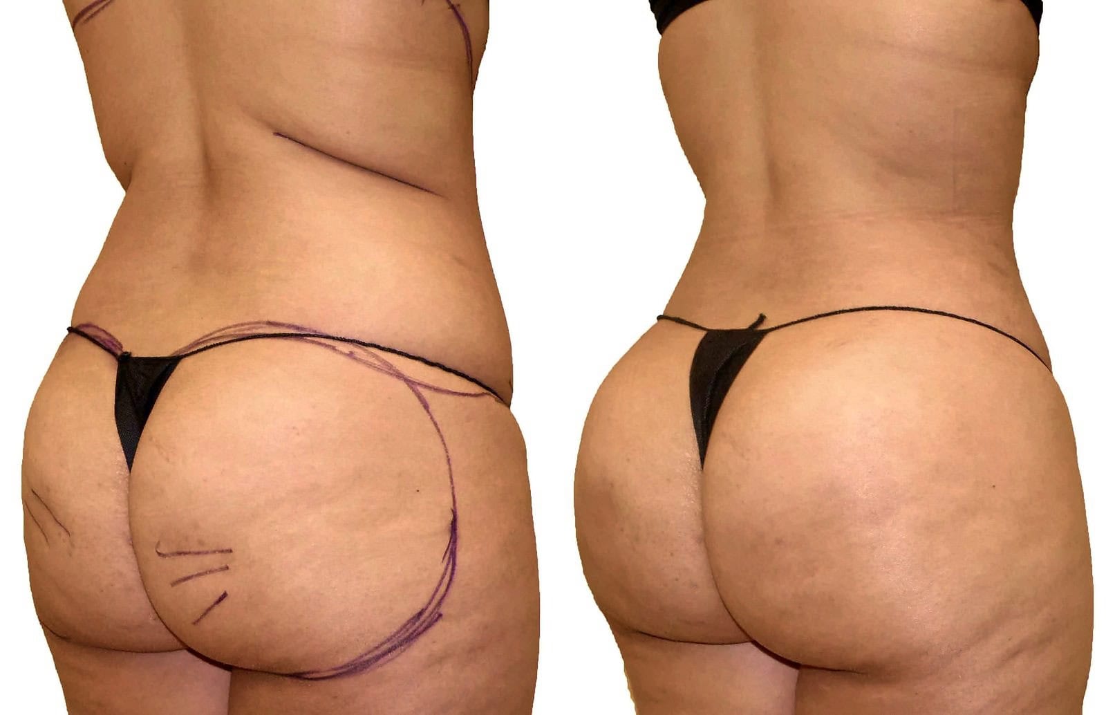 Fat Transfer, BBL before and after, actual patient of Dr. Long