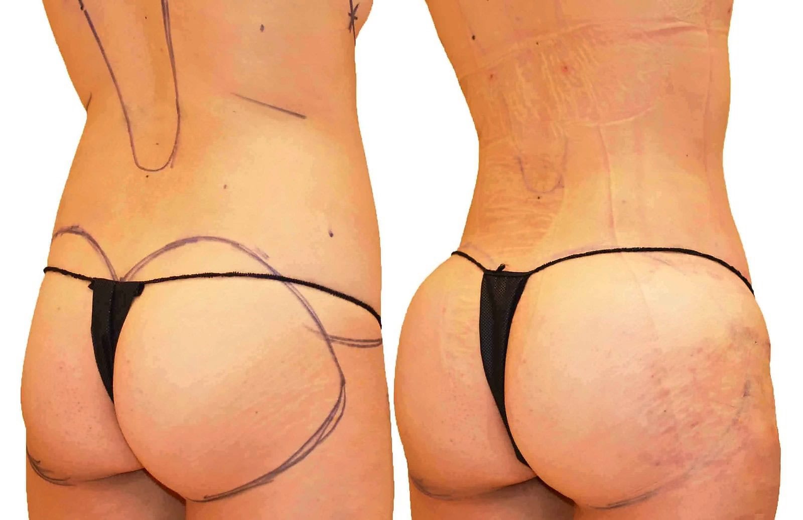 Fat Transfer, BBL before and after, actual patient of Dr. Long
