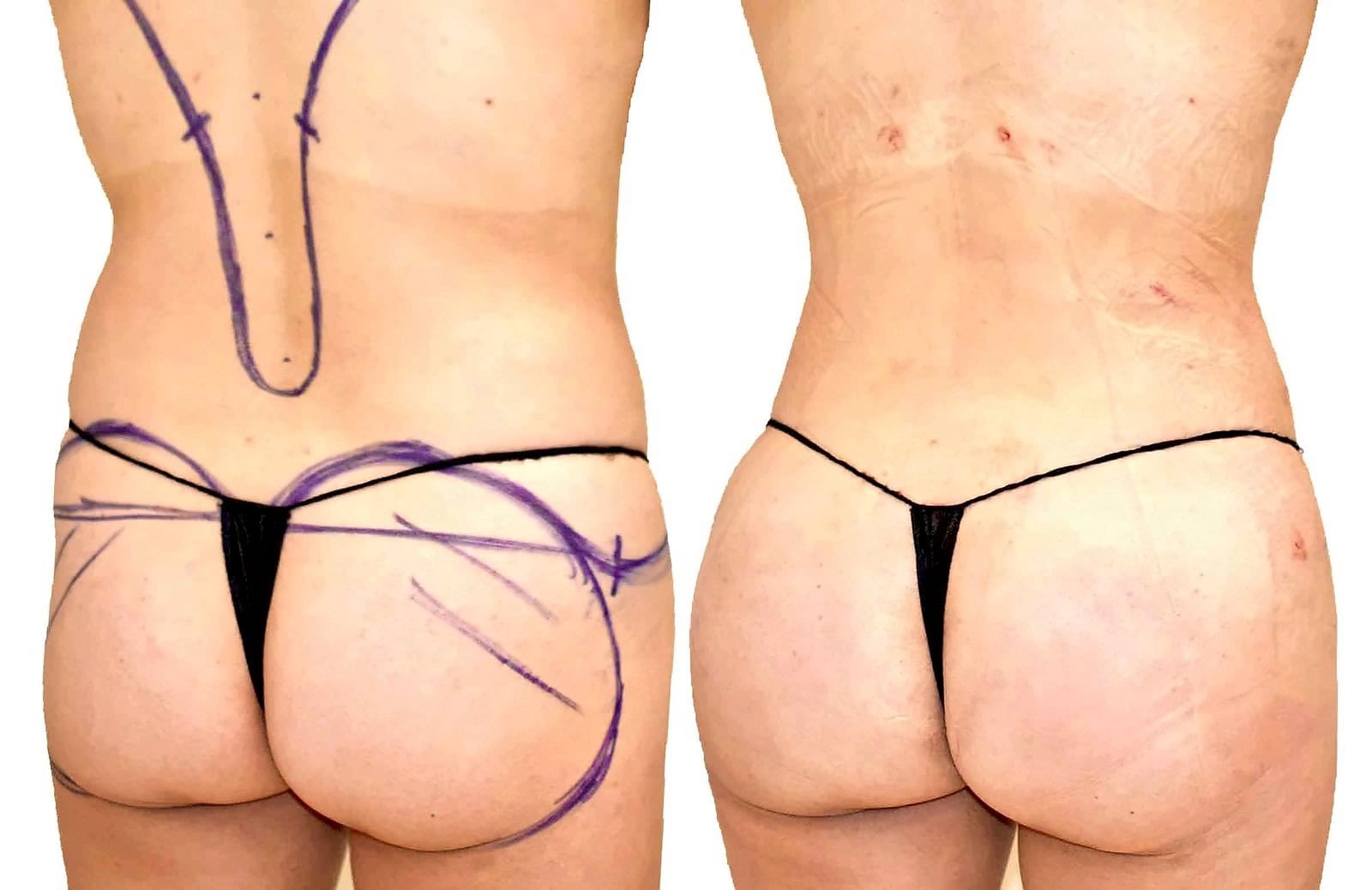 Fat Transfer, BBL before and after, actual patient of Dr. Long