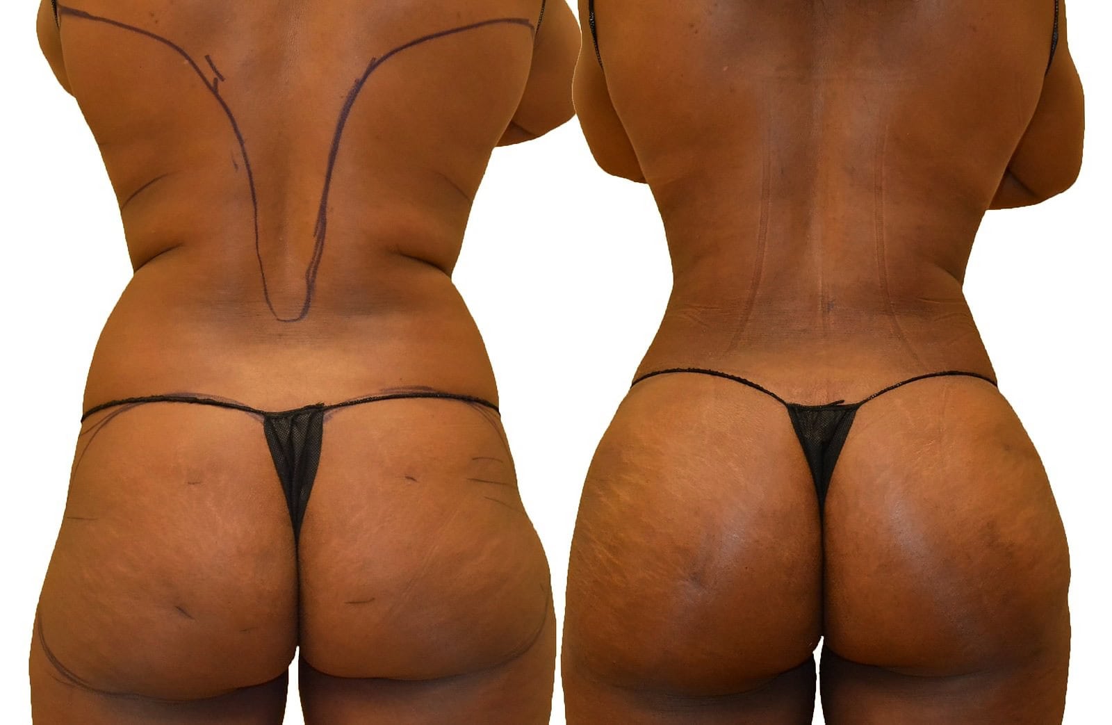 Fat Transfer, BBL before and after, actual patient of Dr. Long