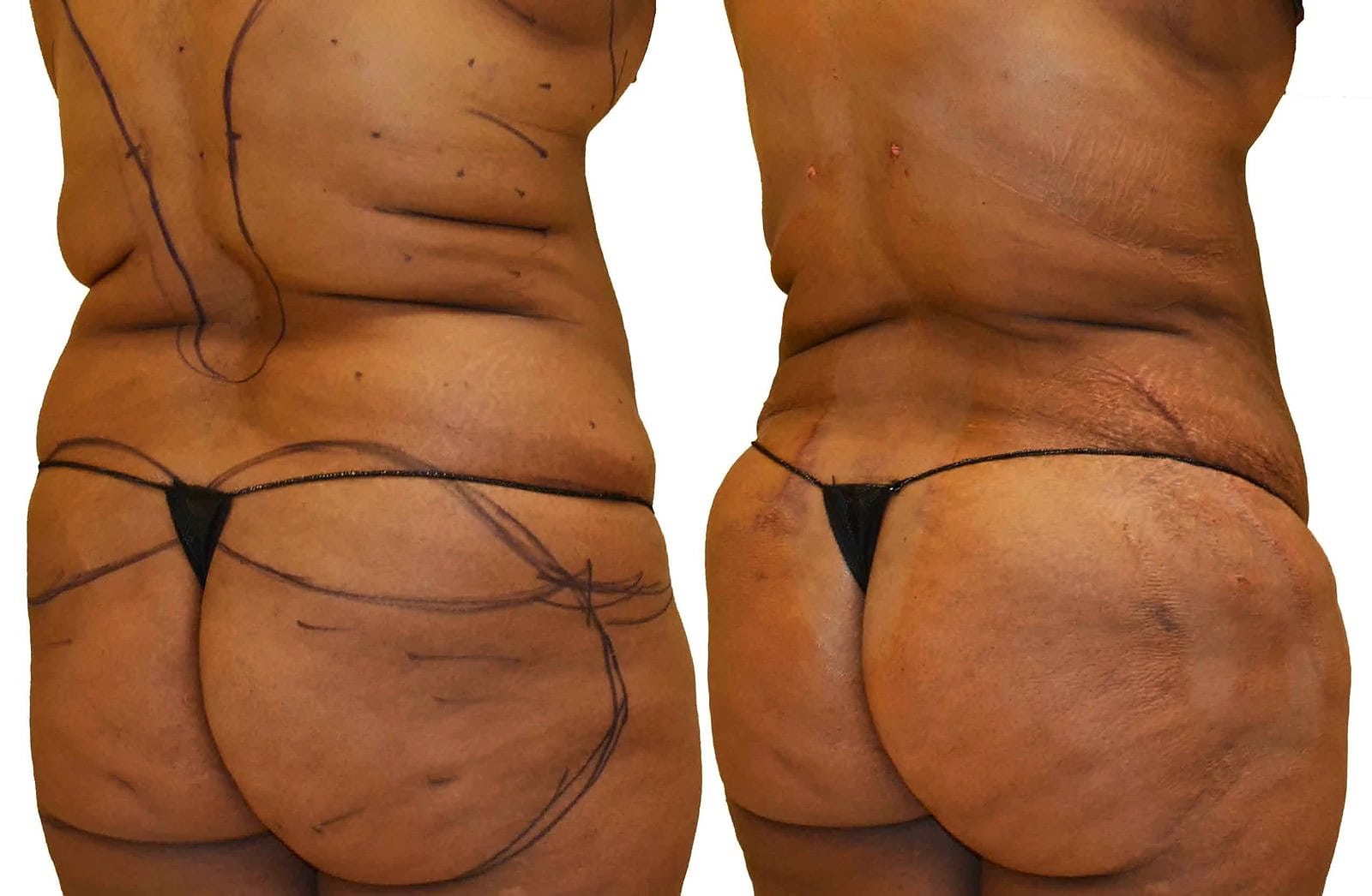 Fat Transfer, BBL before and after, actual patient of Dr. Long