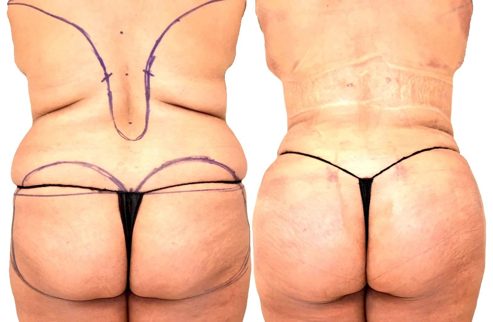 Lipo 360 before and after, actual patient of Dr. Long