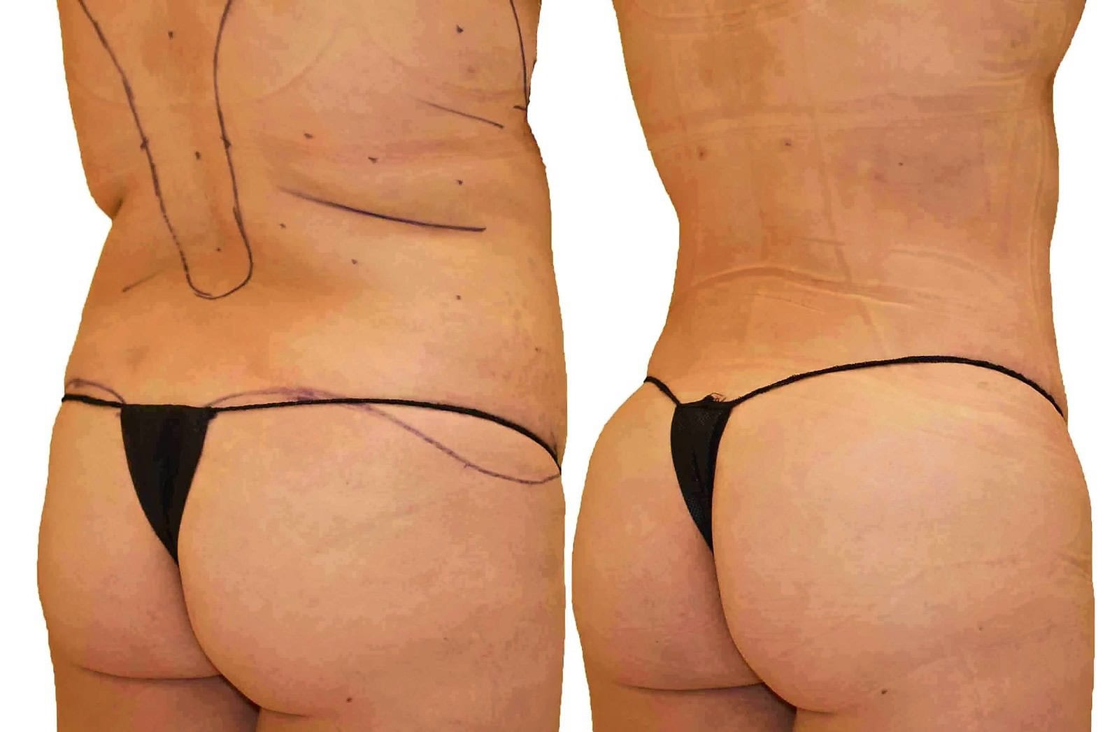 Fat Transfer, BBL before and after, actual patient of Dr. Long