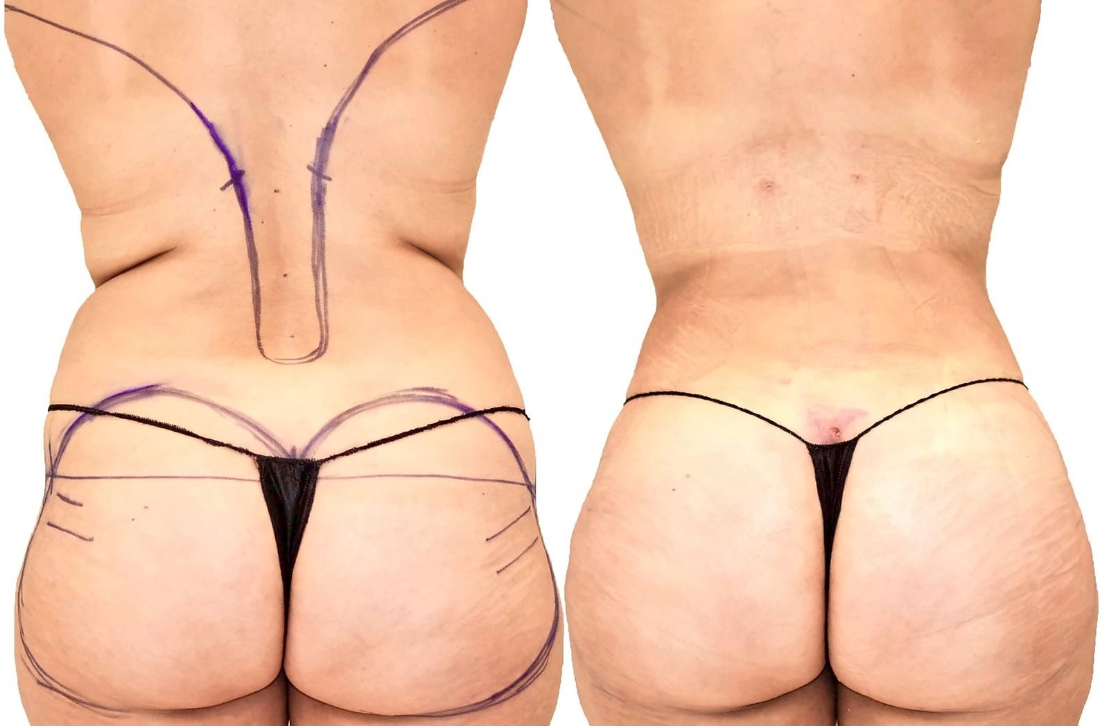 Fat Transfer, BBL before and after, actual patient of Dr. Long
