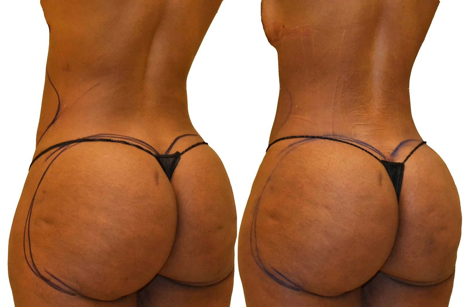 Fat Transfer, BBL before and after, actual patient of Dr. Long