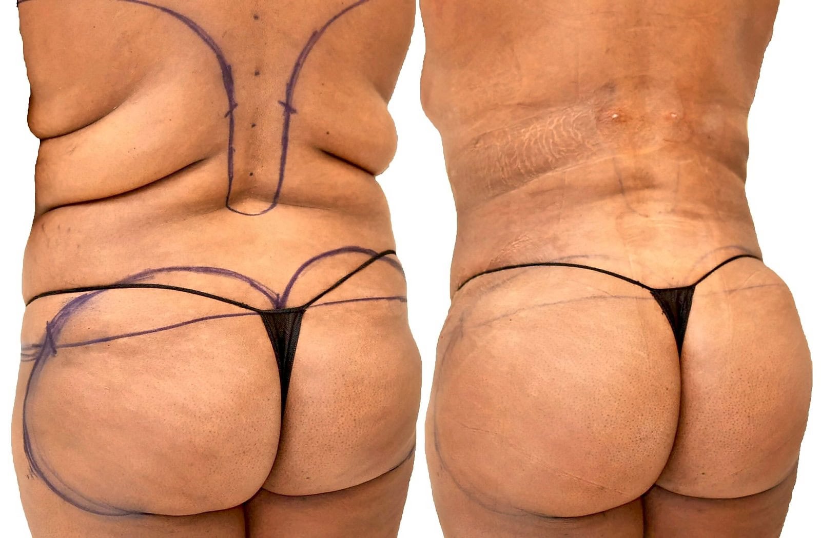 Fat Transfer, BBL before and after, actual patient of Dr. Long