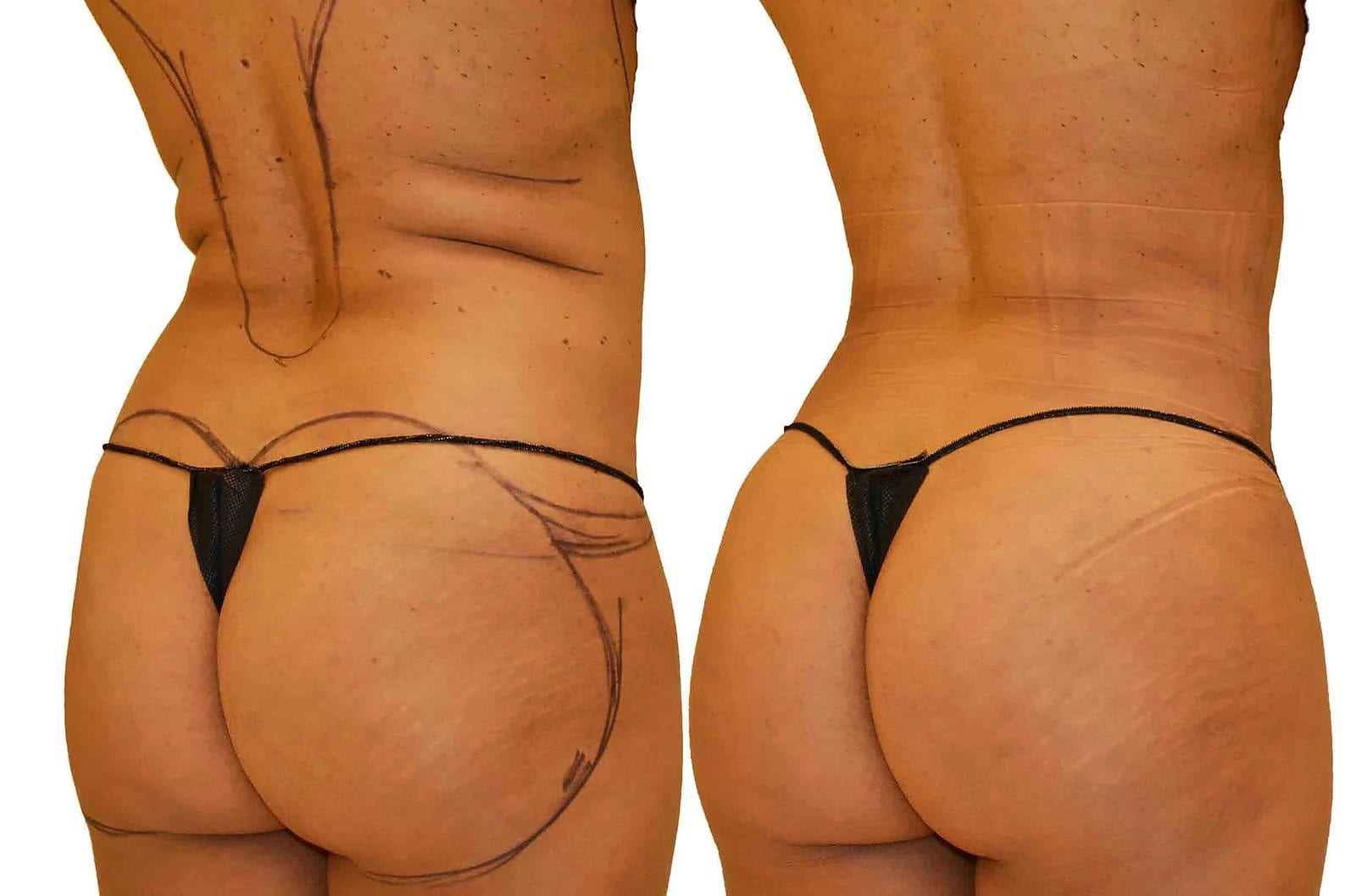 Fat Transfer, BBL before and after, actual patient of Dr. Long