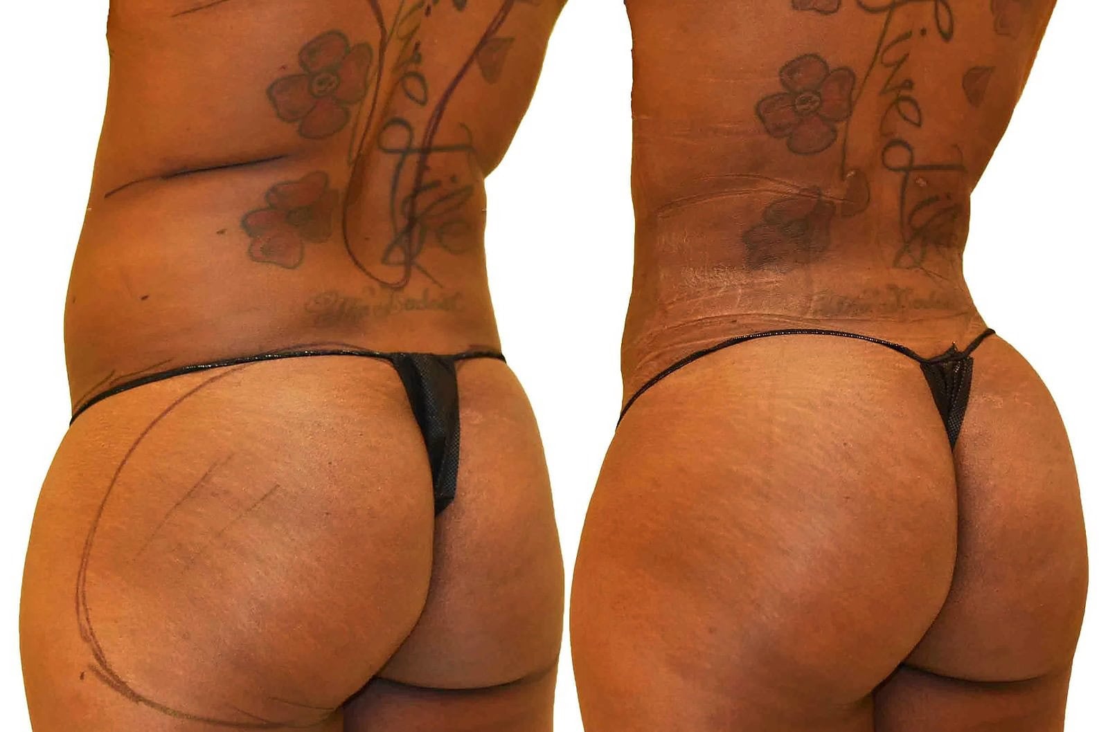 Fat Transfer, BBL before and after, actual patient of Dr. Long