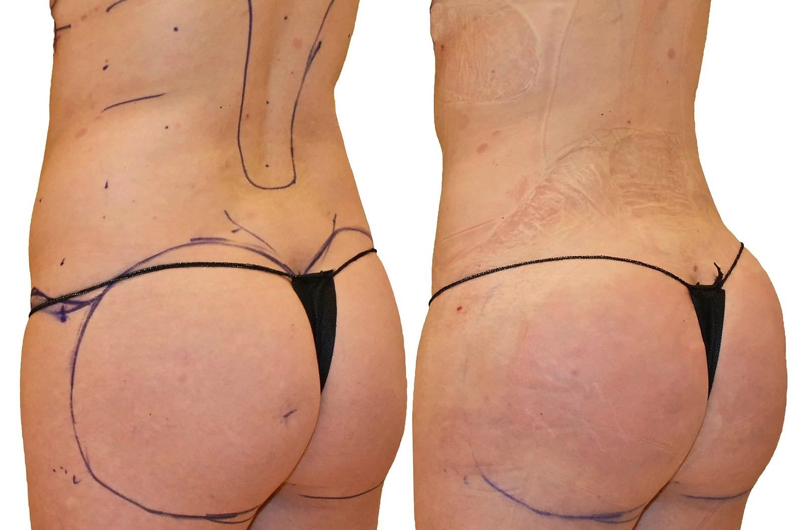 Fat Transfer, BBL before and after, actual patient of Dr. Long