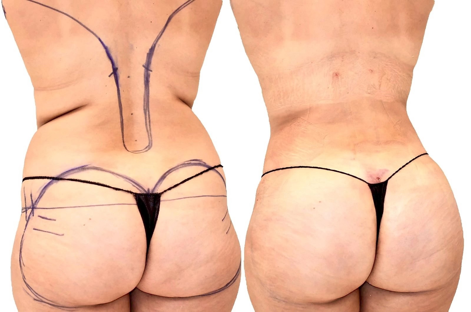 Fat Transfer, BBL before and after, actual patient of Dr. Long