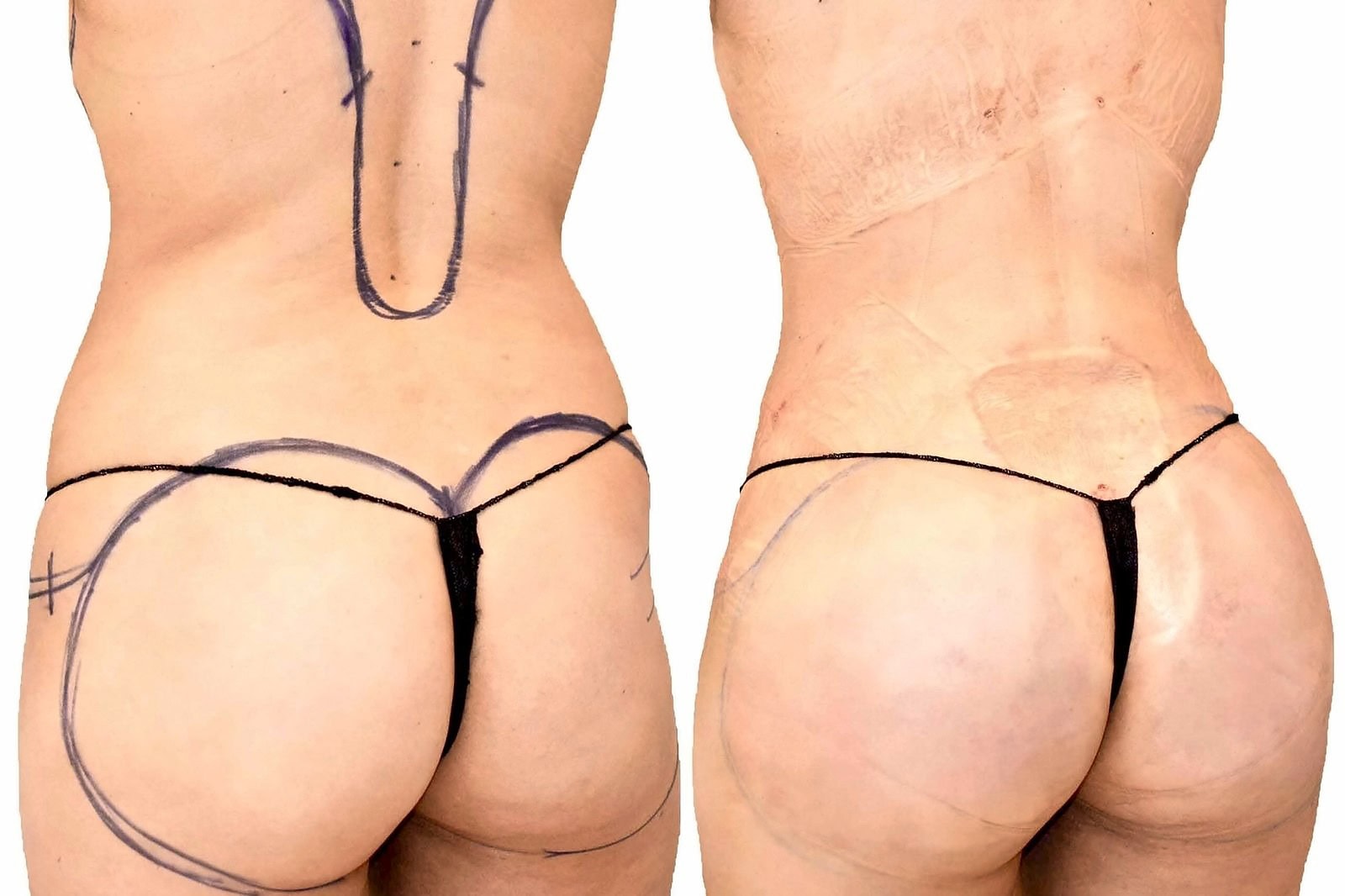 Fat Transfer, BBL before and after, actual patient of Dr. Long