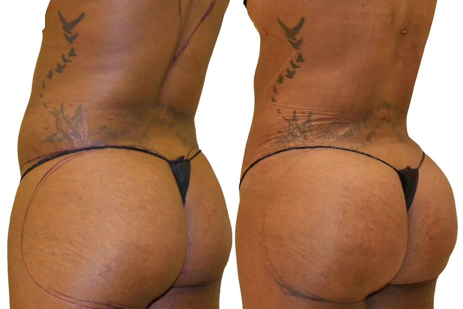Fat Transfer, BBL before and after, actual patient of Dr. Long