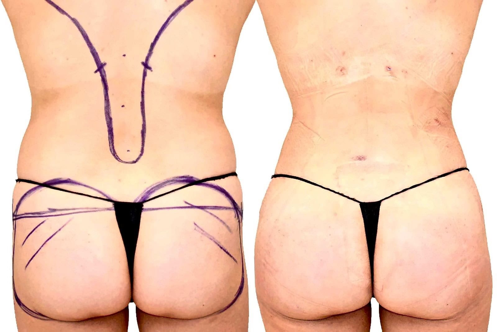 Fat Transfer, BBL before and after, actual patient of Dr. Long