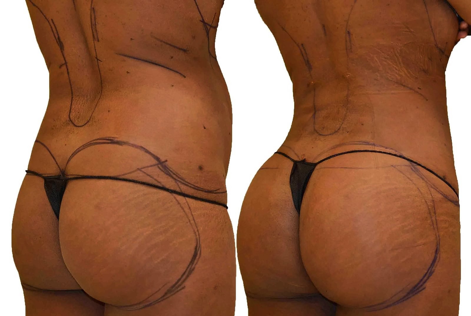 Fat Transfer, BBL before and after, actual patient of Dr. Long