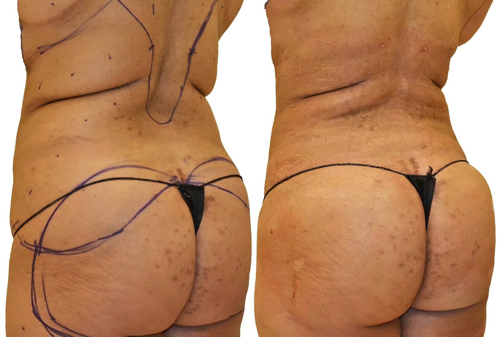 Fat Transfer, BBL before and after, actual patient of Dr. Long