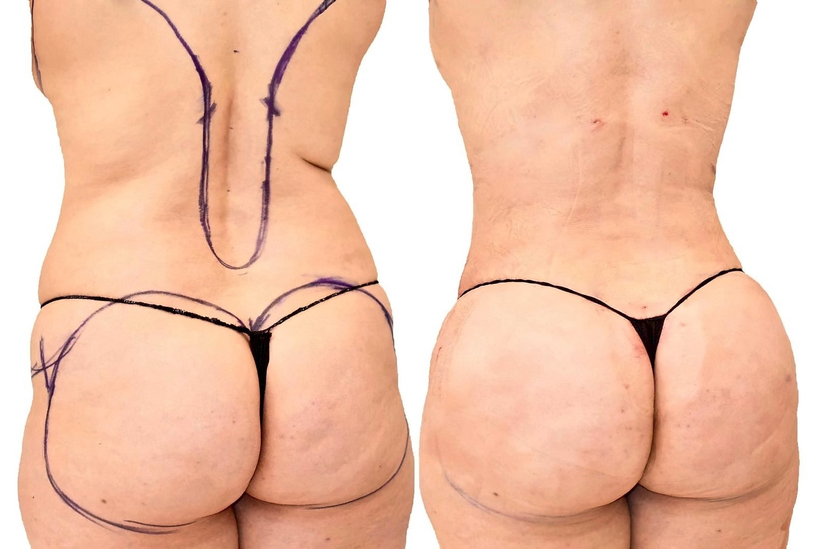 Fat Transfer, BBL before and after, actual patient of Dr. Long