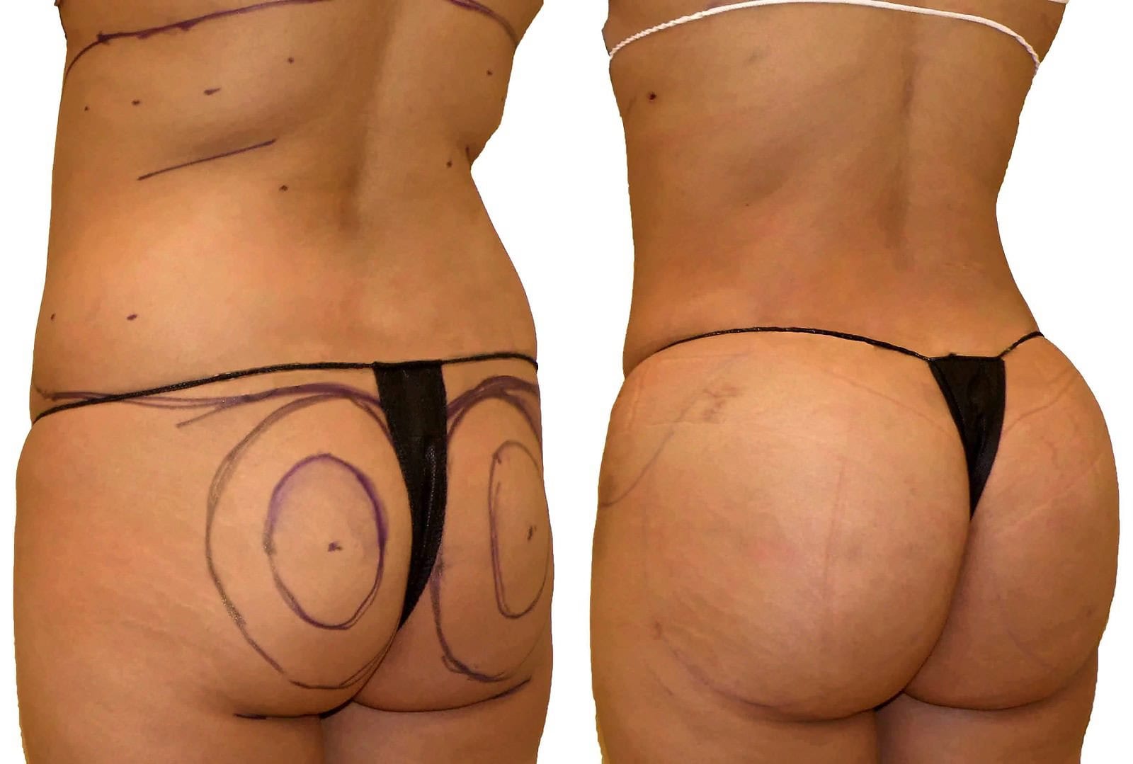 Fat Transfer, BBL before and after, actual patient of Dr. Long