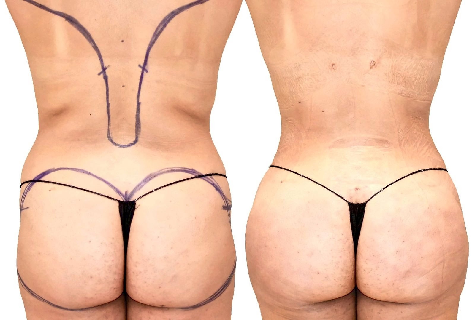 Fat Transfer, BBL before and after, actual patient of Dr. Long