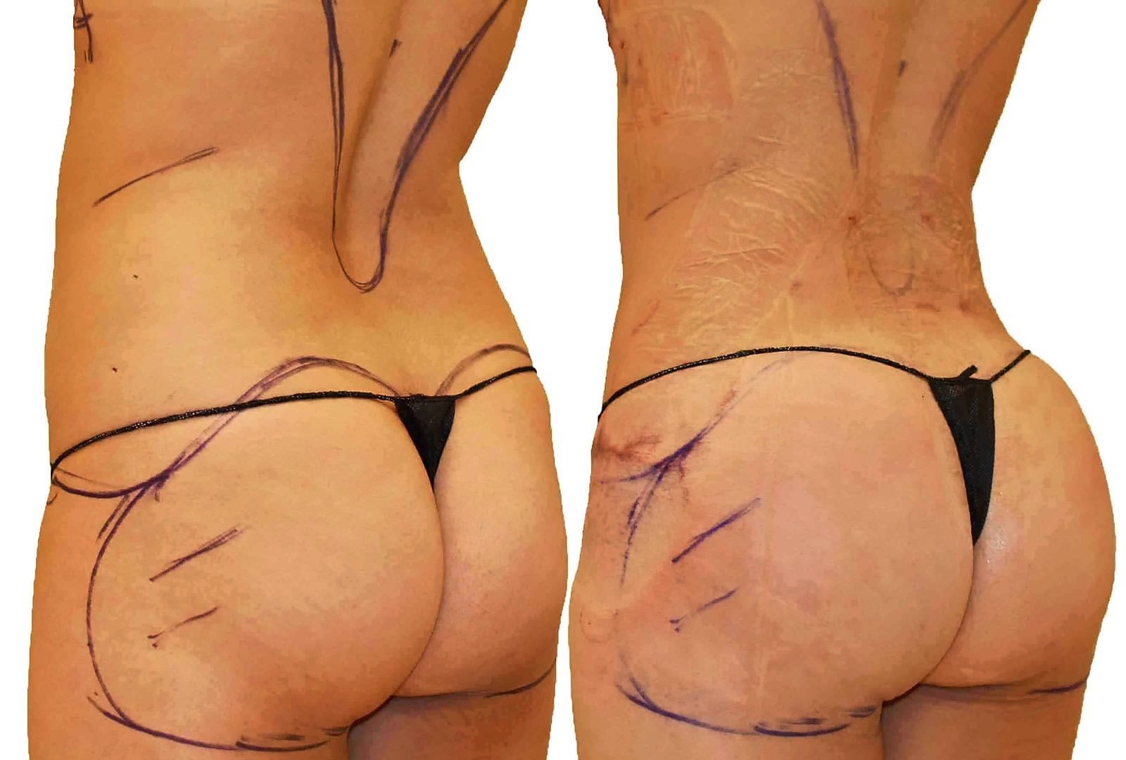 Fat Transfer, BBL before and after, actual patient of Dr. Long