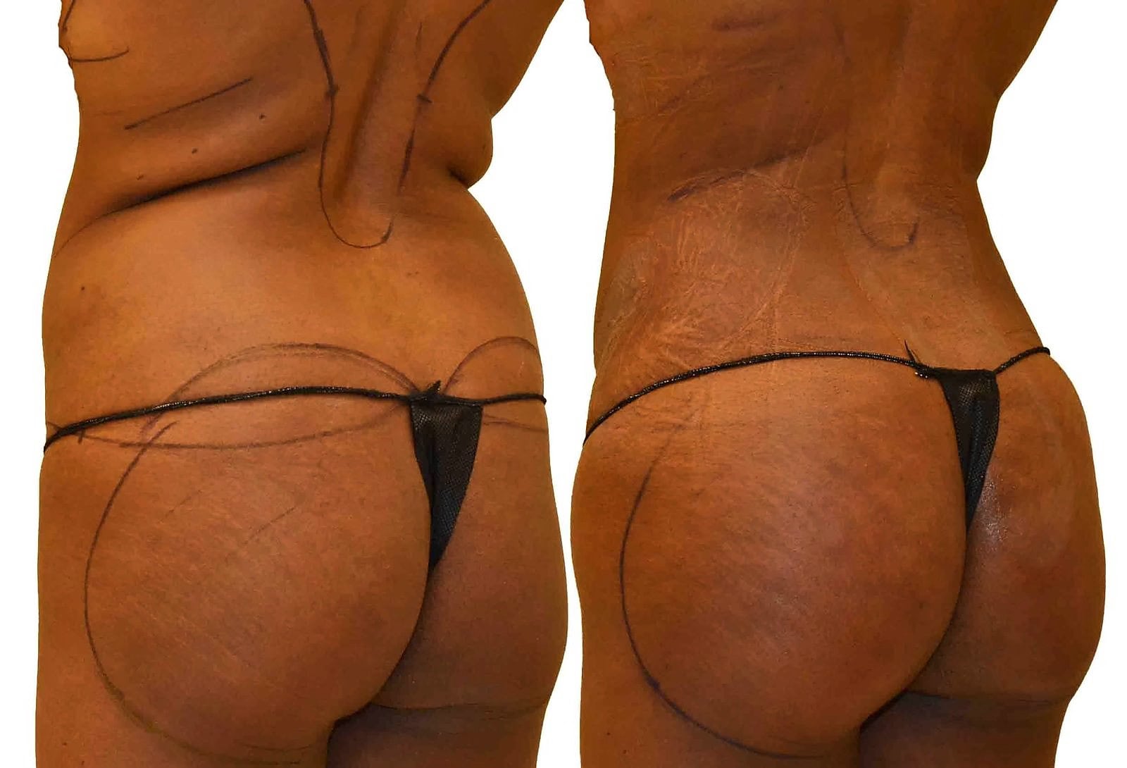 Fat Transfer, BBL before and after, actual patient of Dr. Long