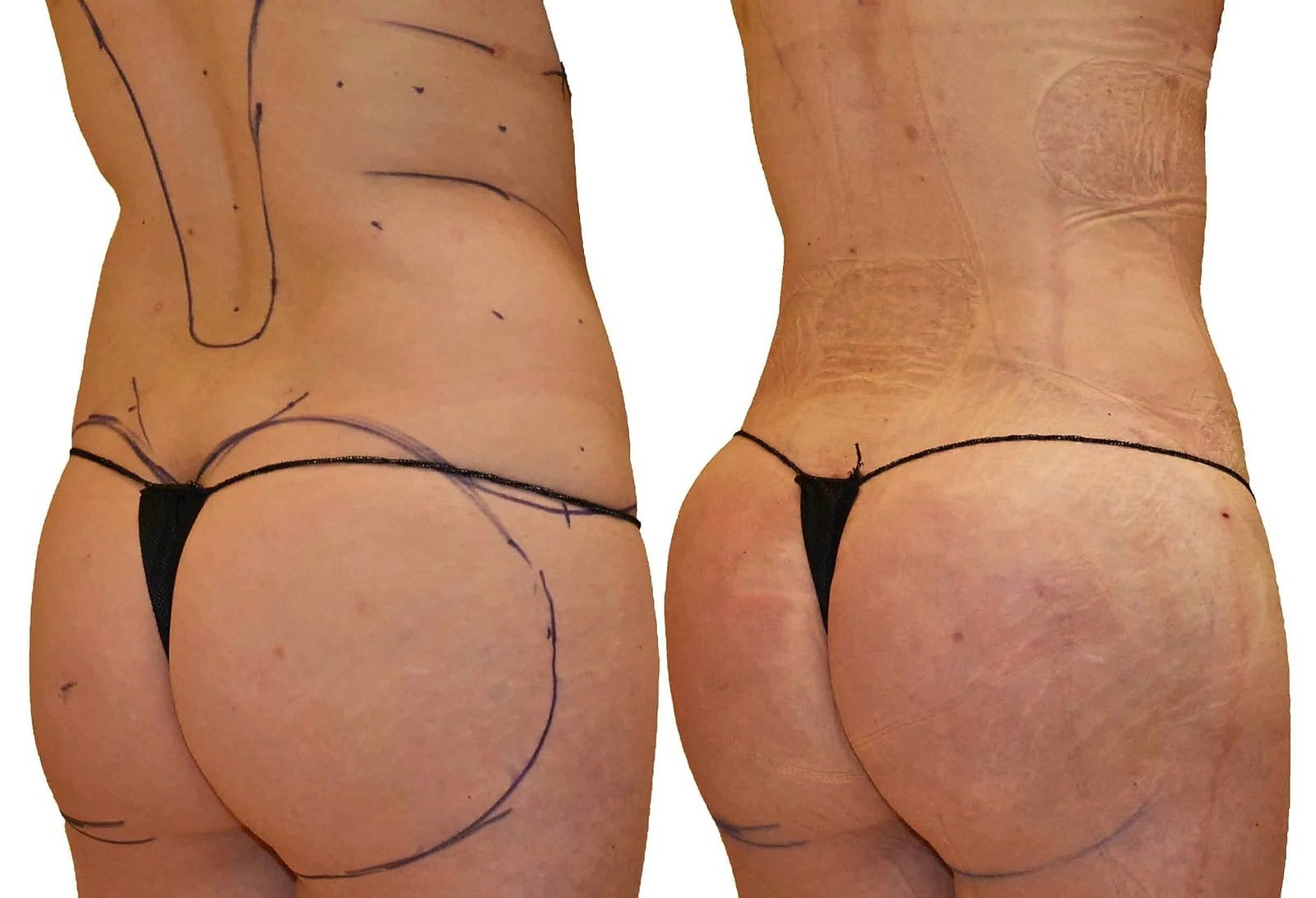 Fat Transfer, BBL before and after, actual patient of Dr. Long