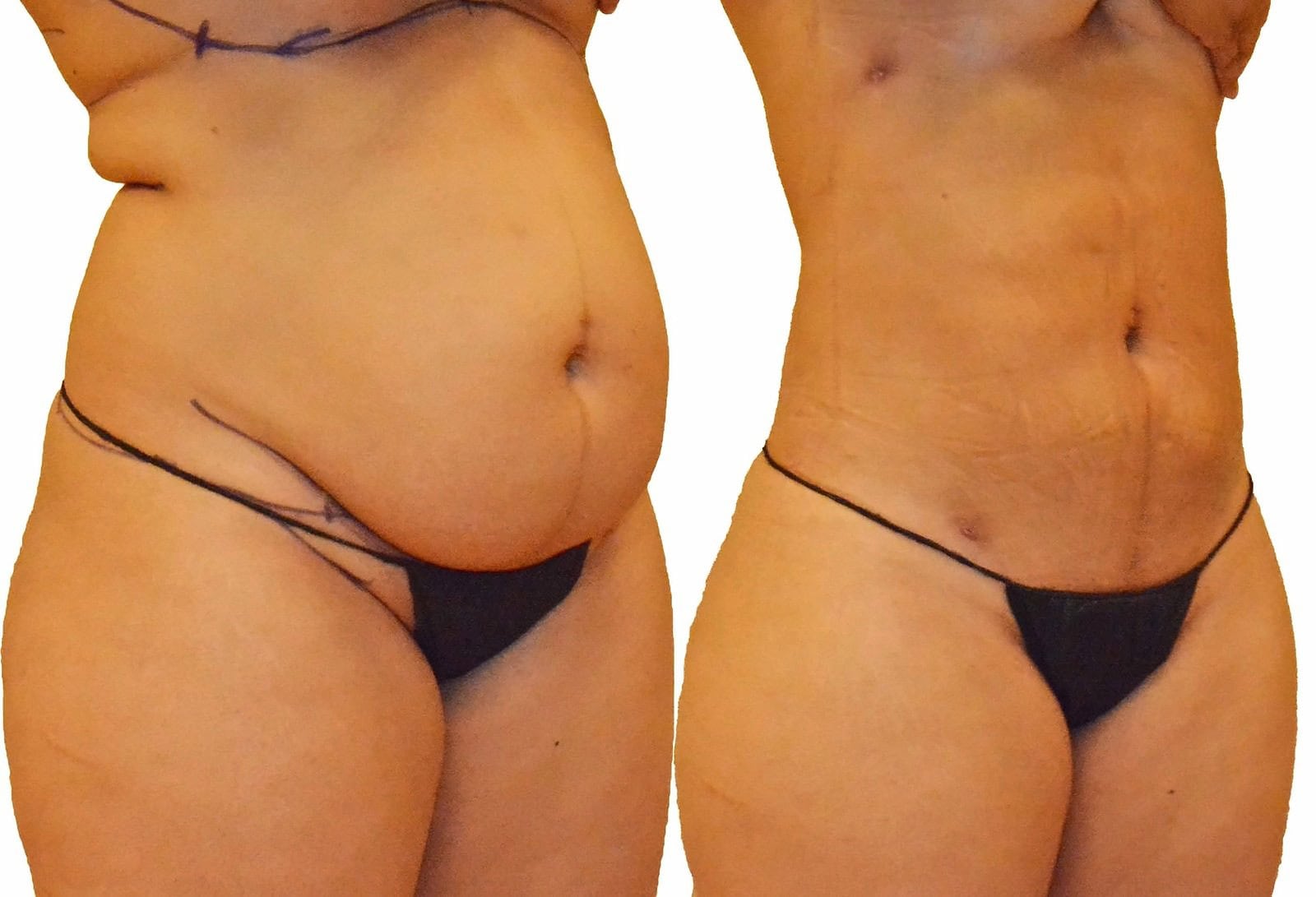 Lipo 360 before and after, actual patient of Dr. Long