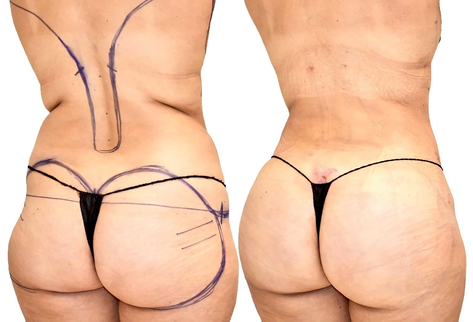 Fat Transfer, BBL before and after, actual patient of Dr. Long