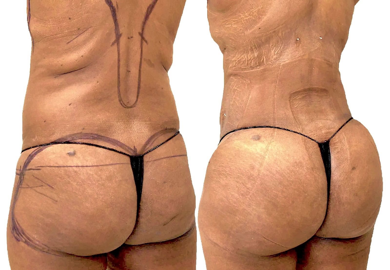 Fat Transfer, BBL before and after, actual patient of Dr. Long