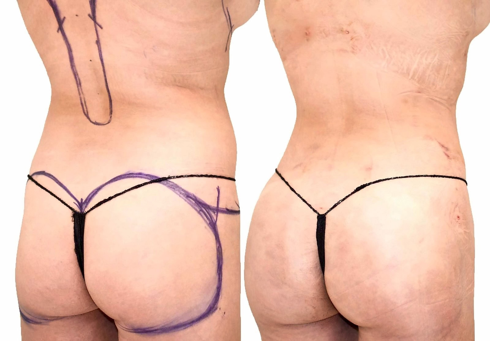 Fat Transfer, BBL before and after, actual patient of Dr. Long