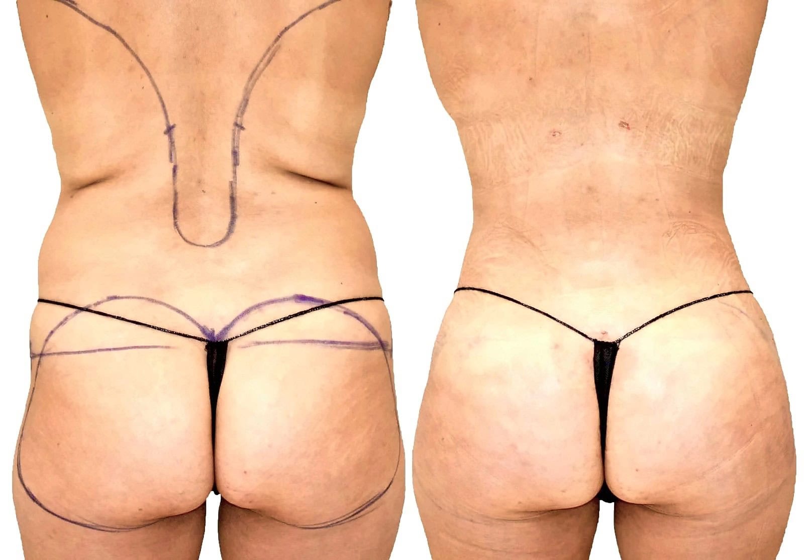 Fat Transfer, BBL before and after, actual patient of Dr. Long
