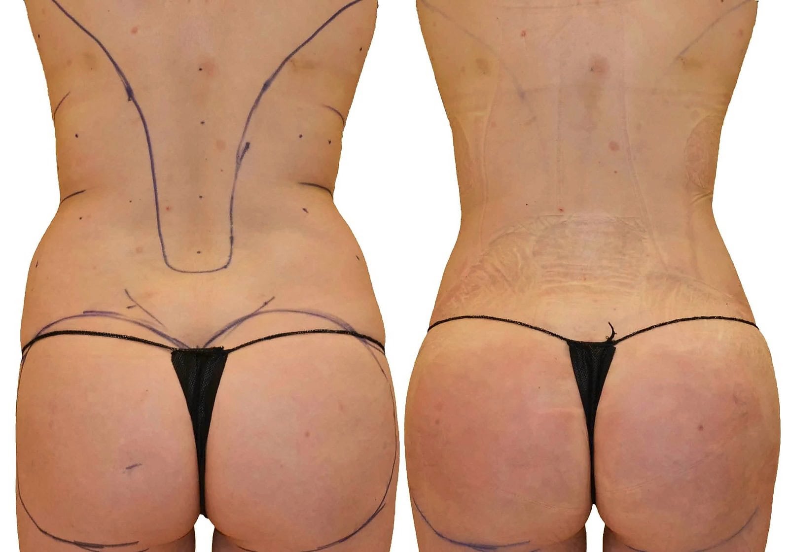 Fat Transfer, BBL before and after, actual patient of Dr. Long
