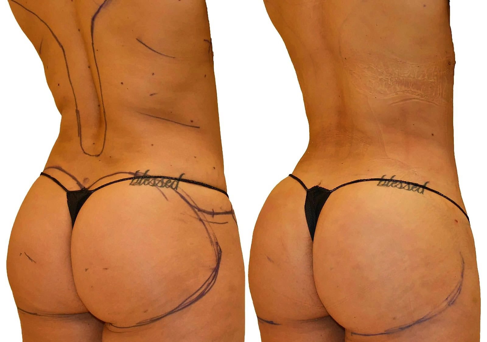Fat Transfer, BBL before and after, actual patient of Dr. Long