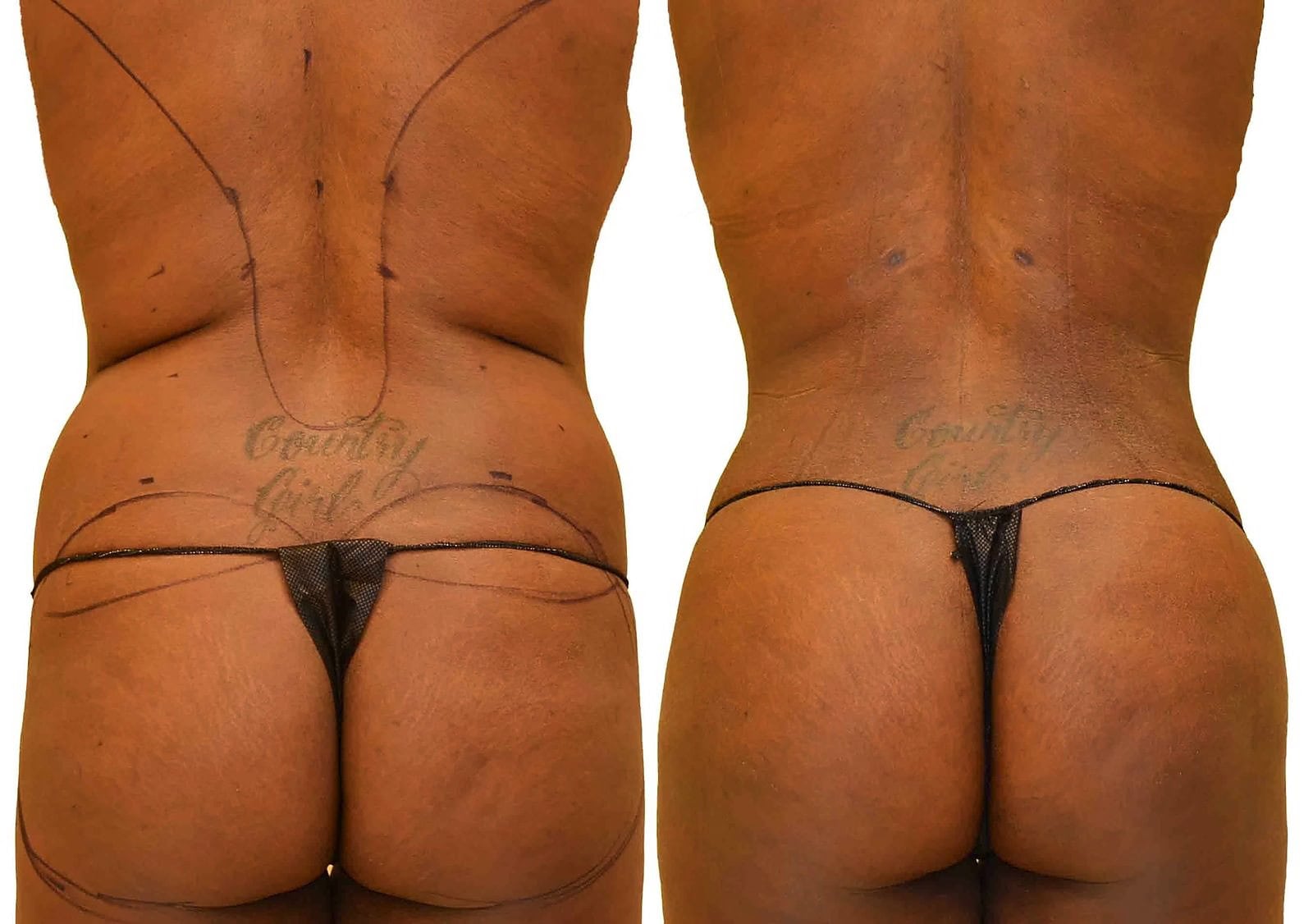 Fat Transfer, BBL before and after, actual patient of Dr. Long