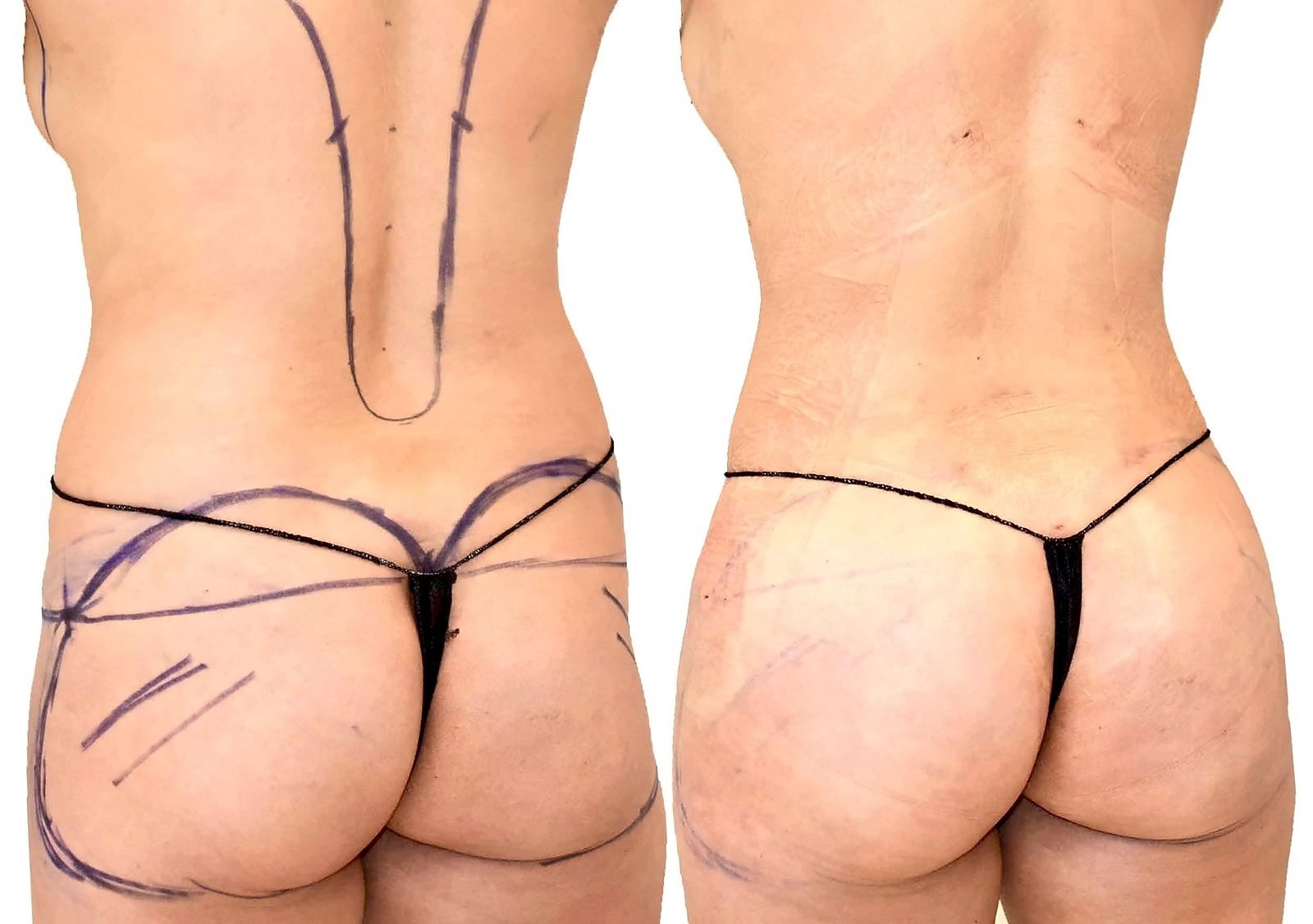 Fat Transfer, BBL before and after, actual patient of Dr. Long