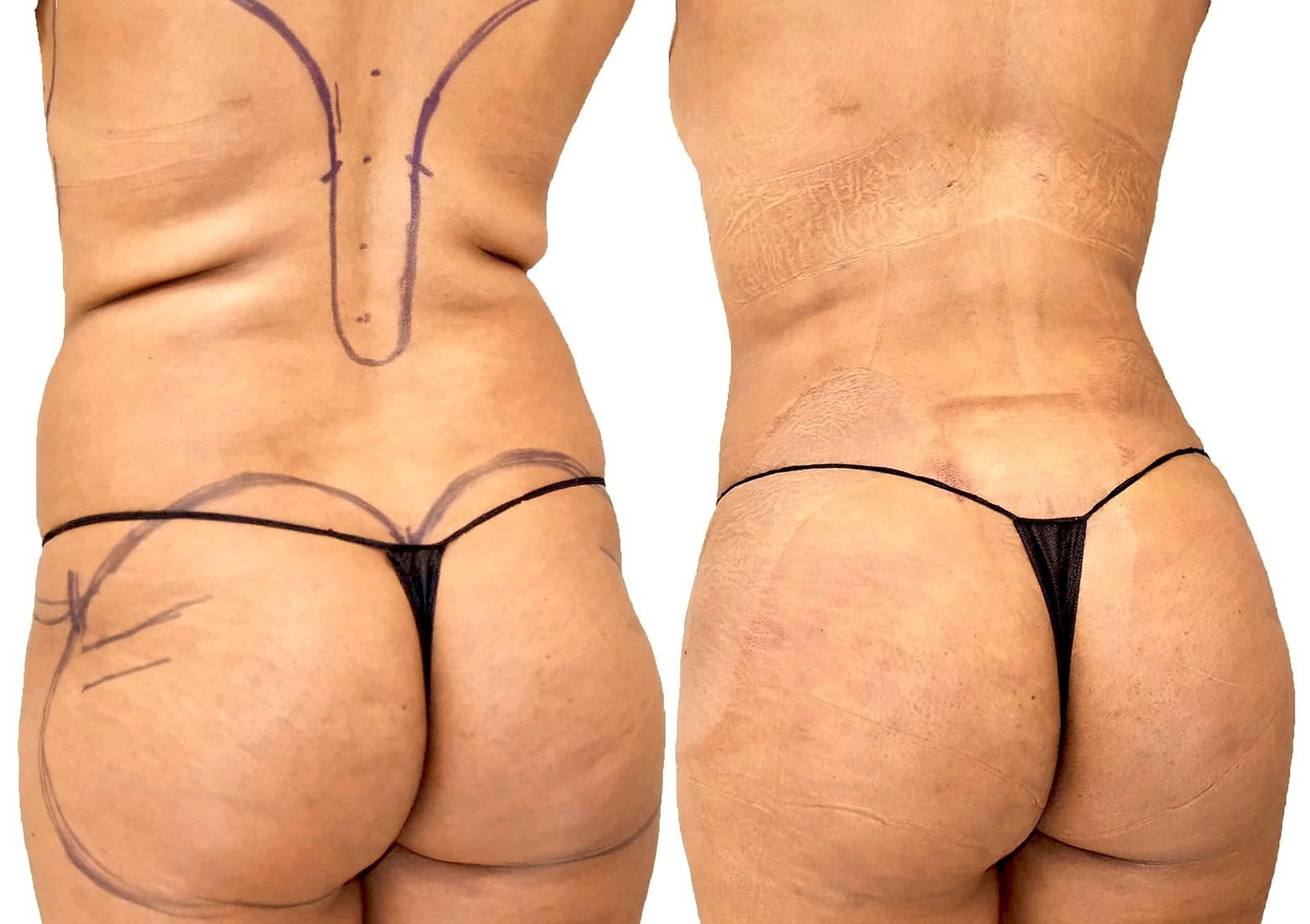 Fat Transfer, BBL before and after, actual patient of Dr. Long