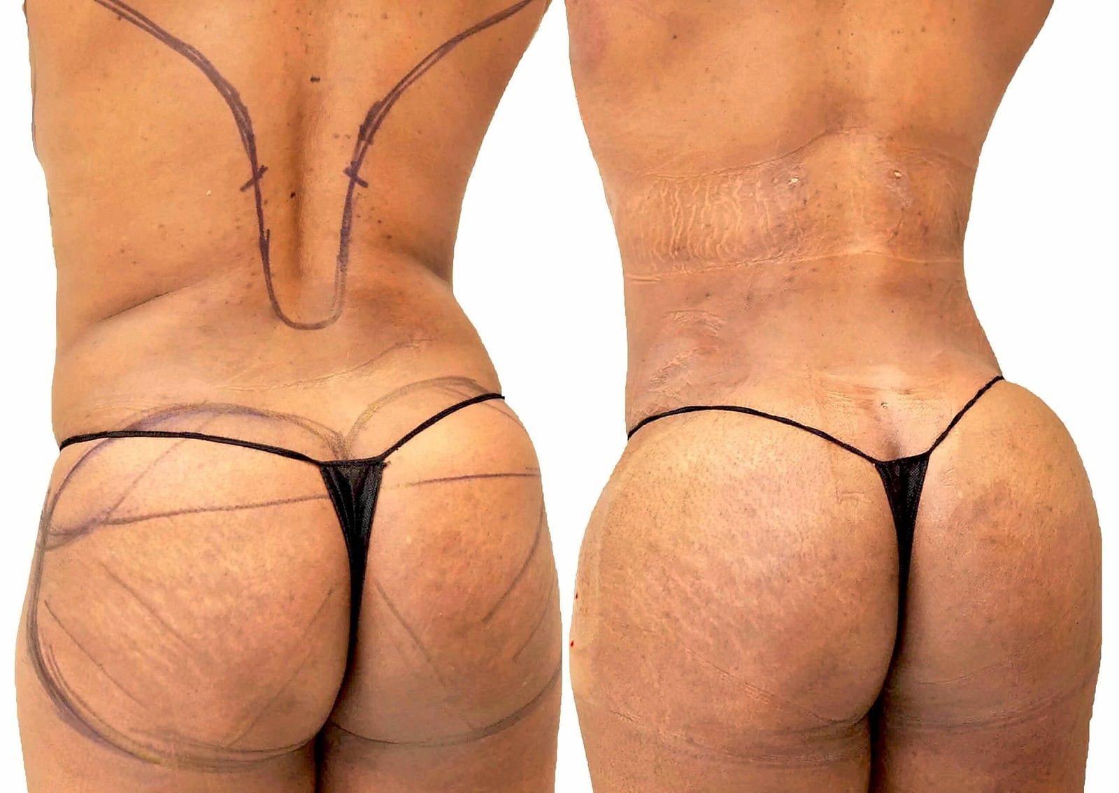 Fat Transfer, BBL before and after, actual patient of Dr. Long