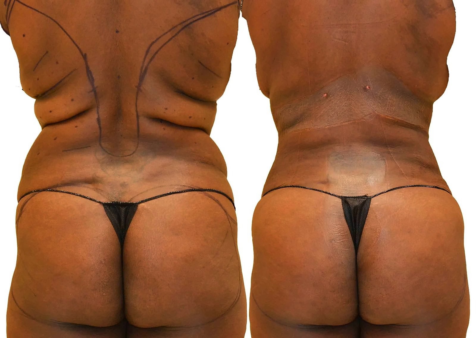 Fat Transfer, BBL before and after, actual patient of Dr. Long