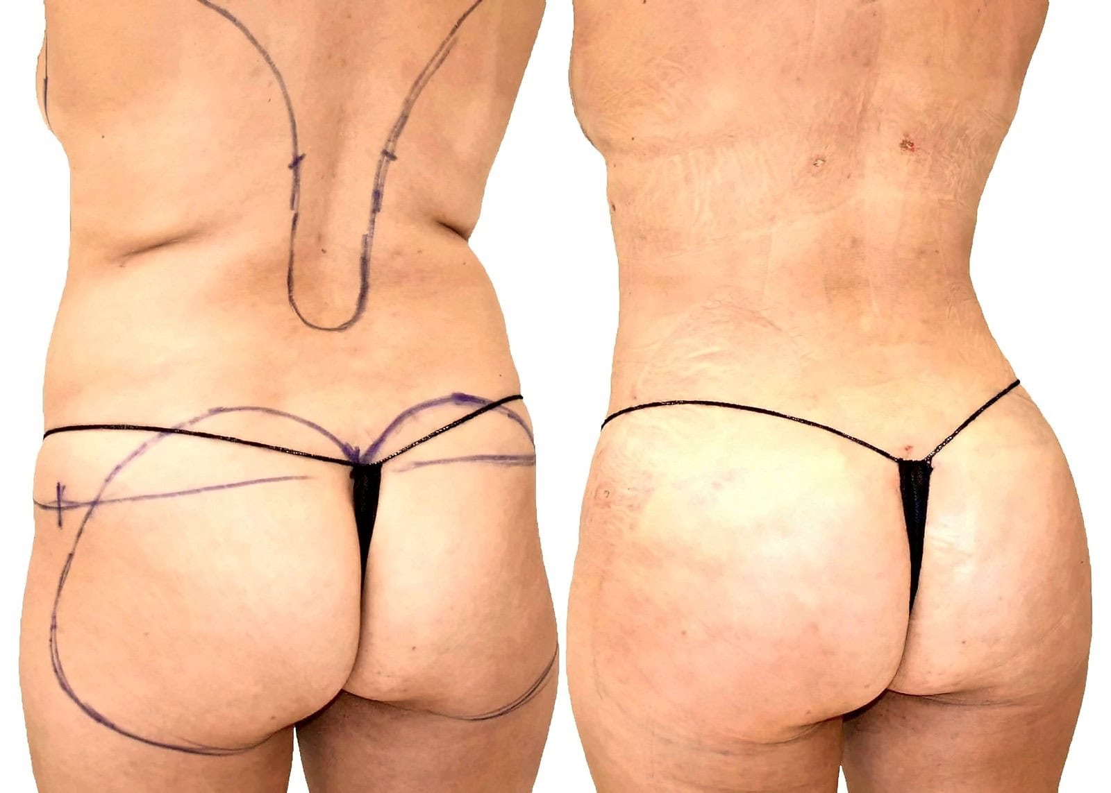 Fat Transfer, BBL before and after, actual patient of Dr. Long