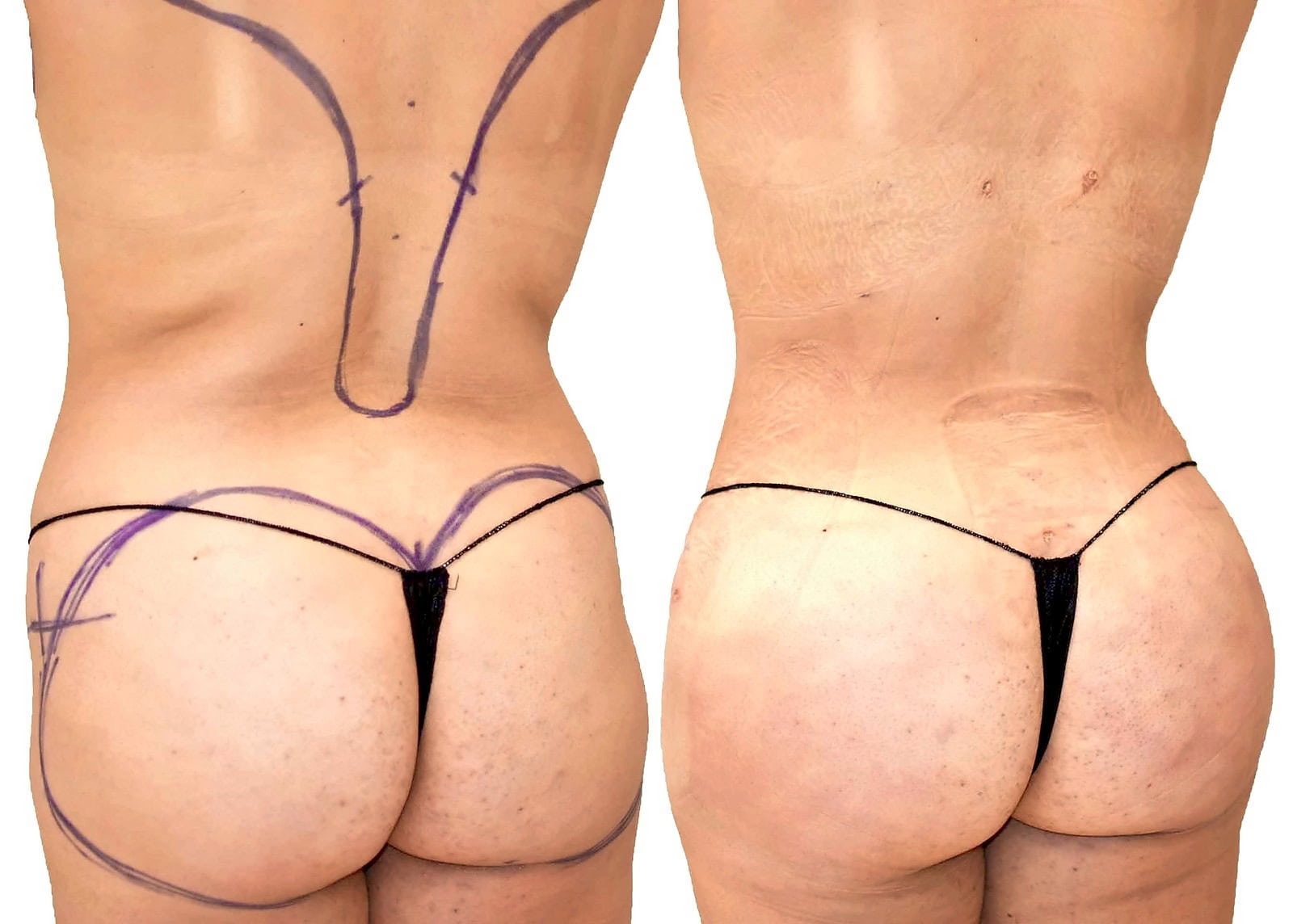 Fat Transfer, BBL before and after, actual patient of Dr. Long