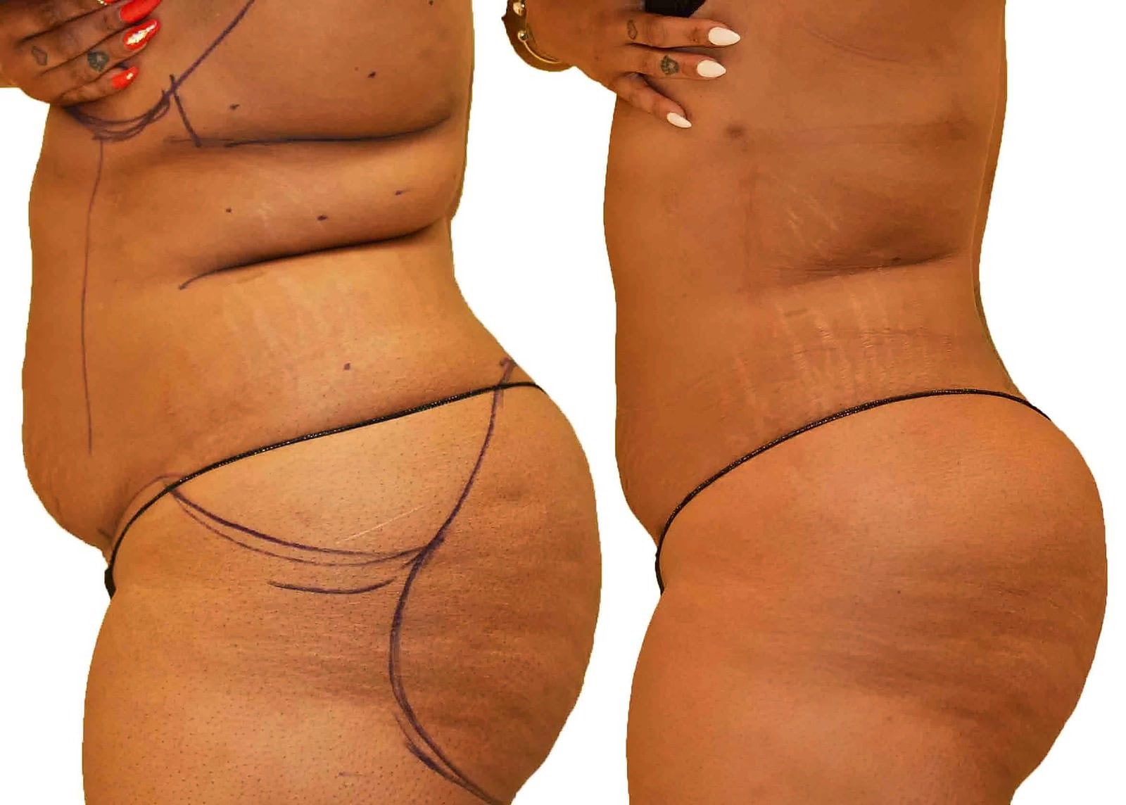 Lipo 360 before and after, actual patient of Dr. Long