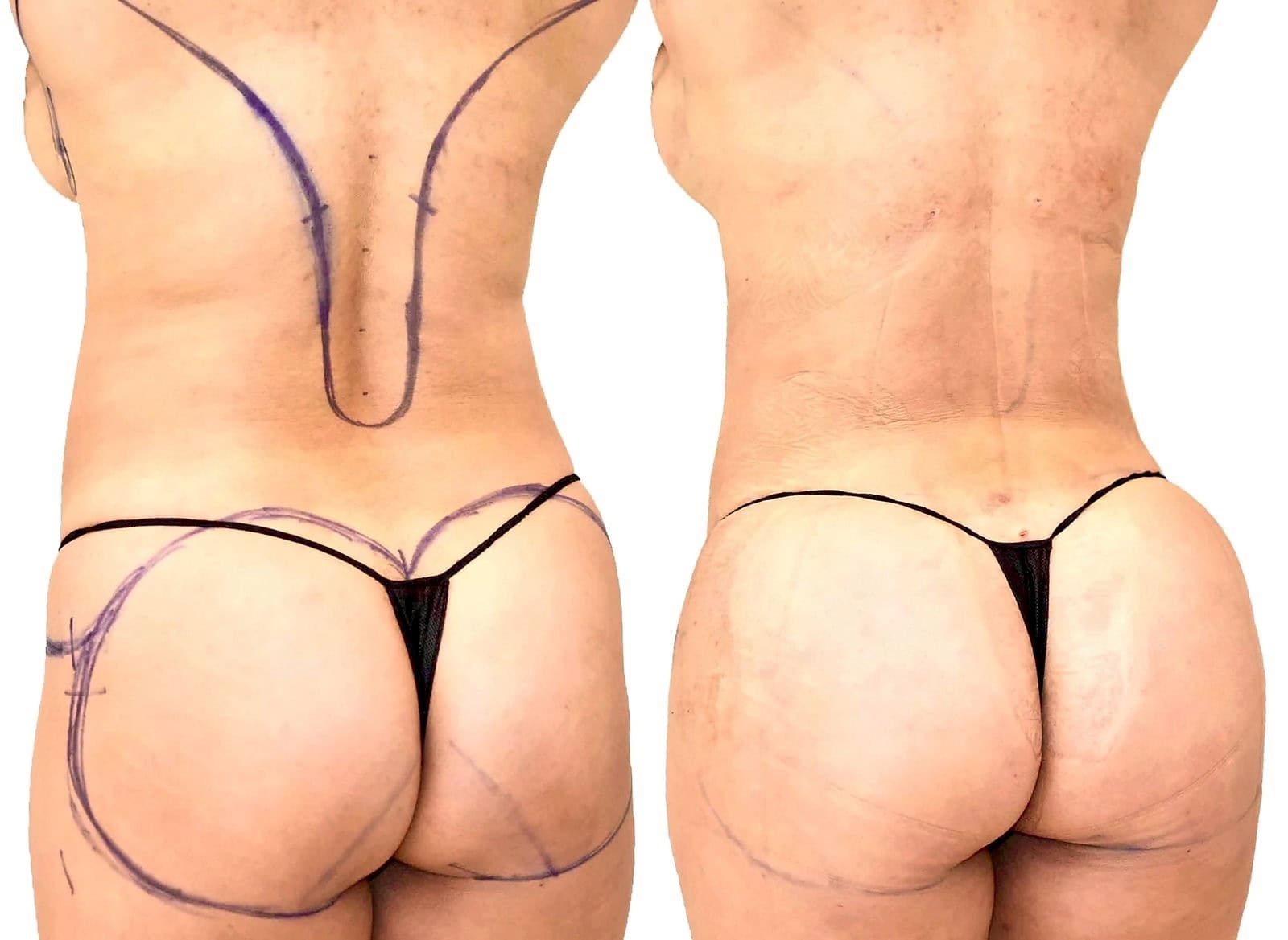 Fat Transfer, BBL before and after, actual patient of Dr. Long