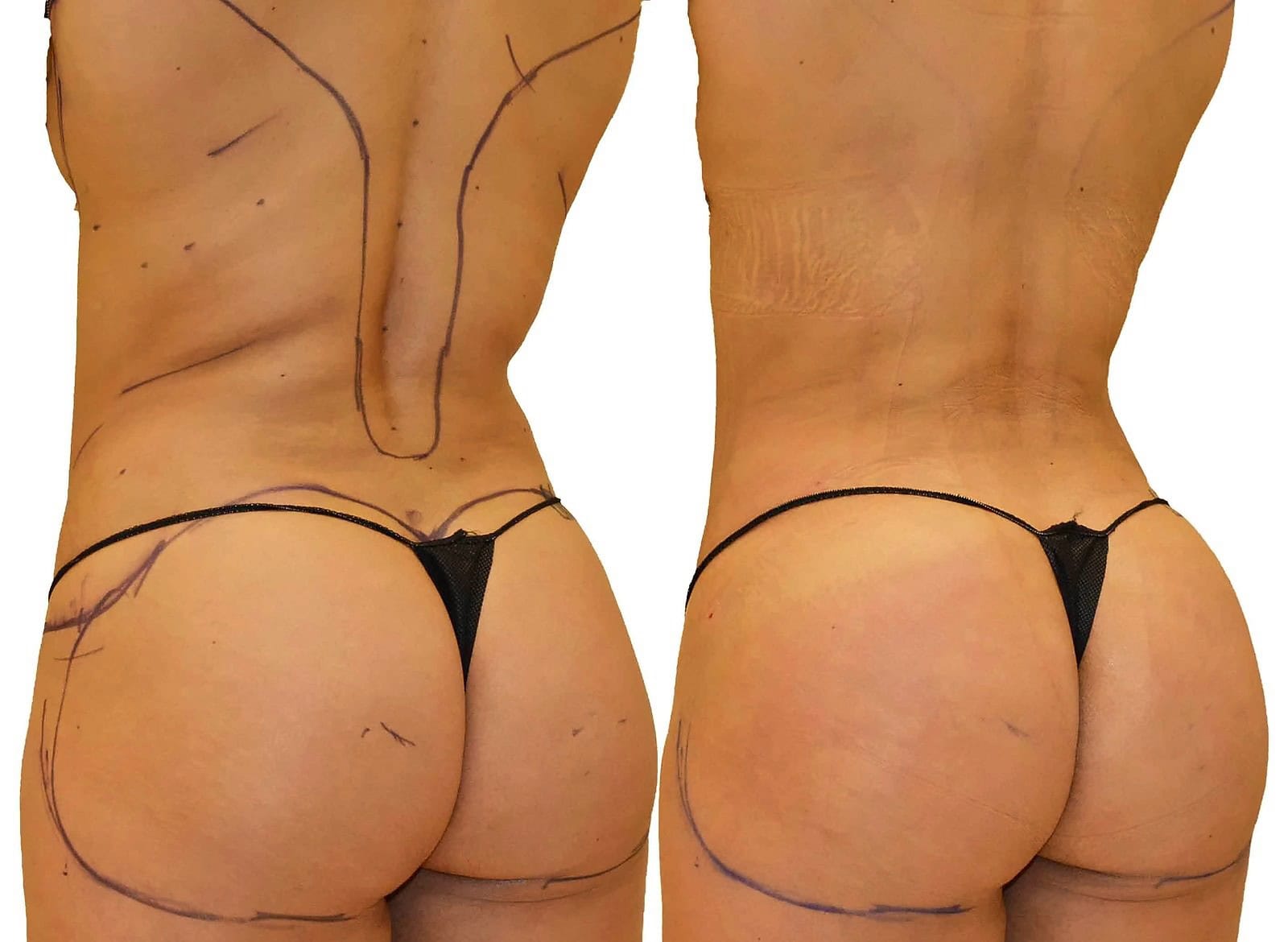 Fat Transfer, BBL before and after, actual patient of Dr. Long