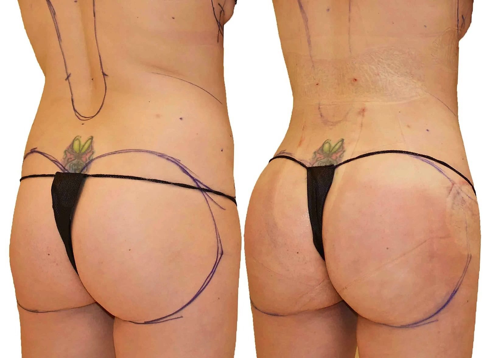 Fat Transfer, BBL before and after, actual patient of Dr. Long