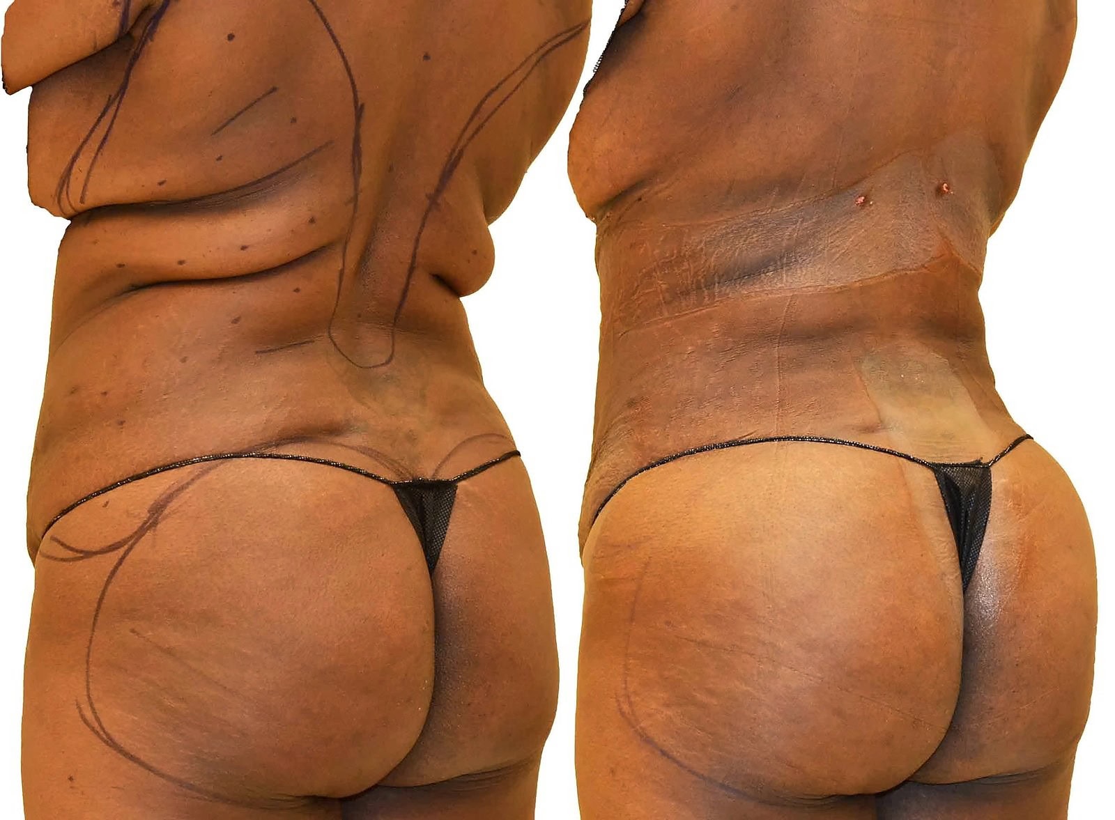 Fat Transfer, BBL before and after, actual patient of Dr. Long