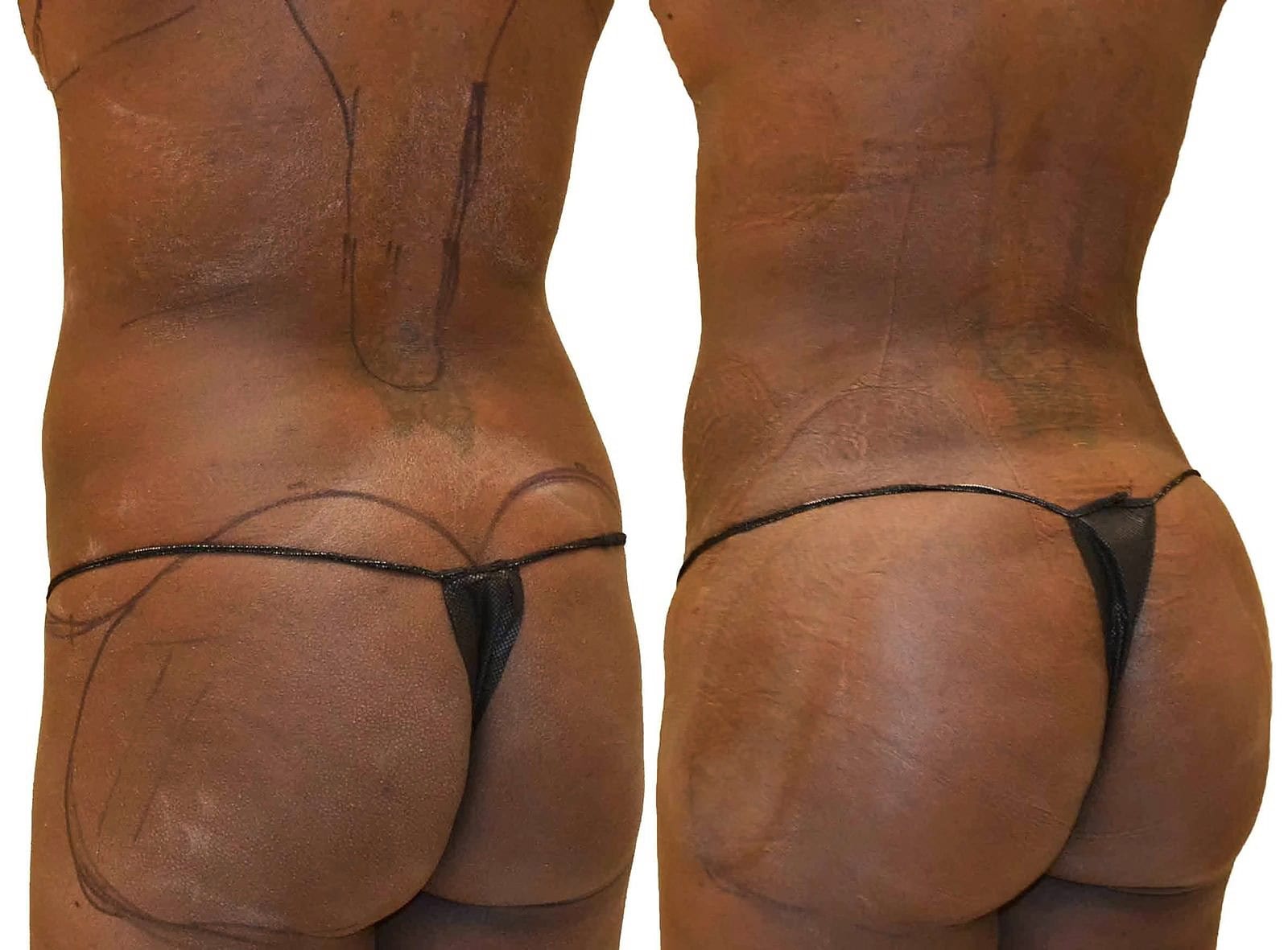 Fat Transfer, BBL before and after, actual patient of Dr. Long
