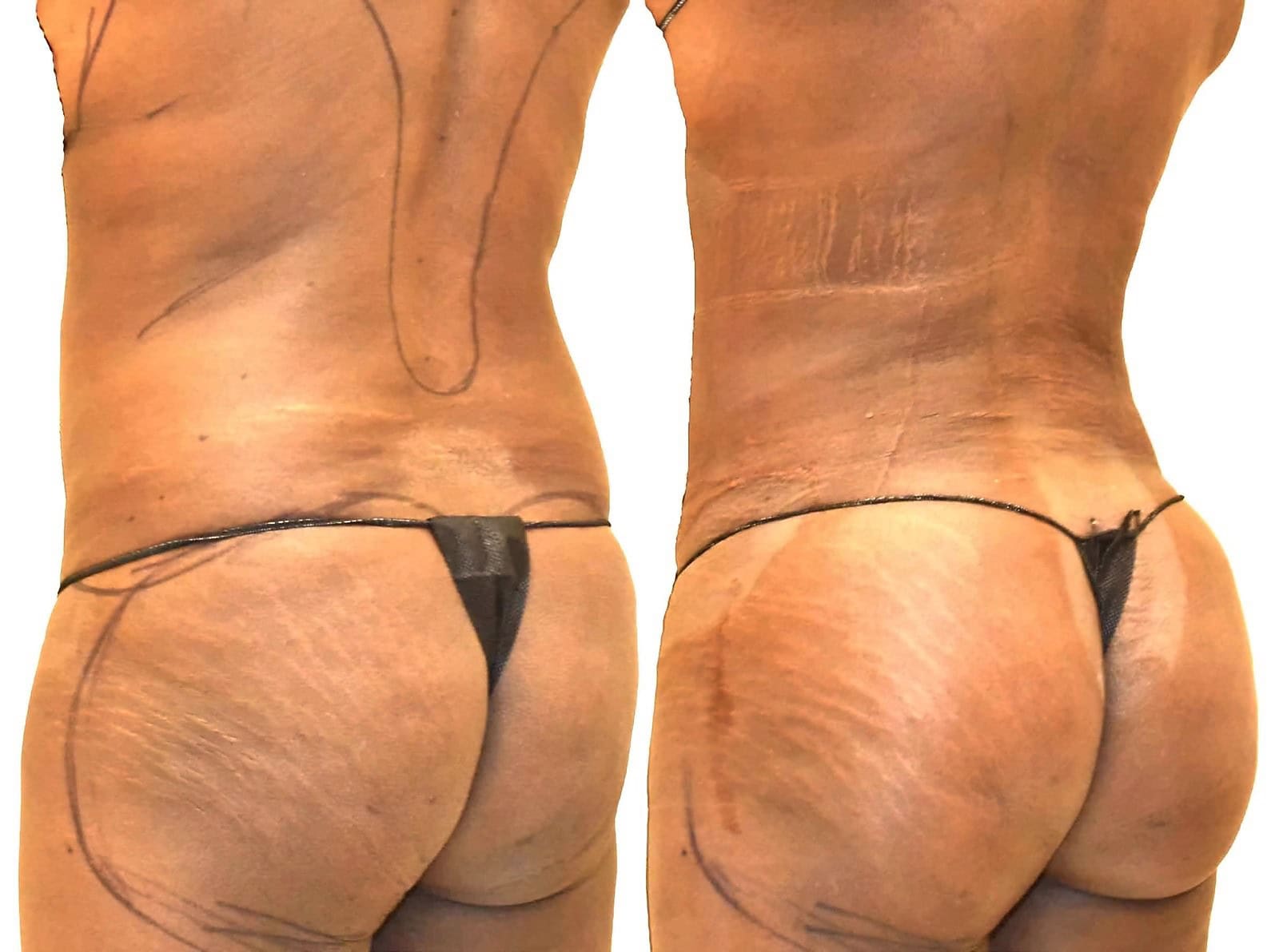 Fat Transfer, BBL before and after, actual patient of Dr. Long