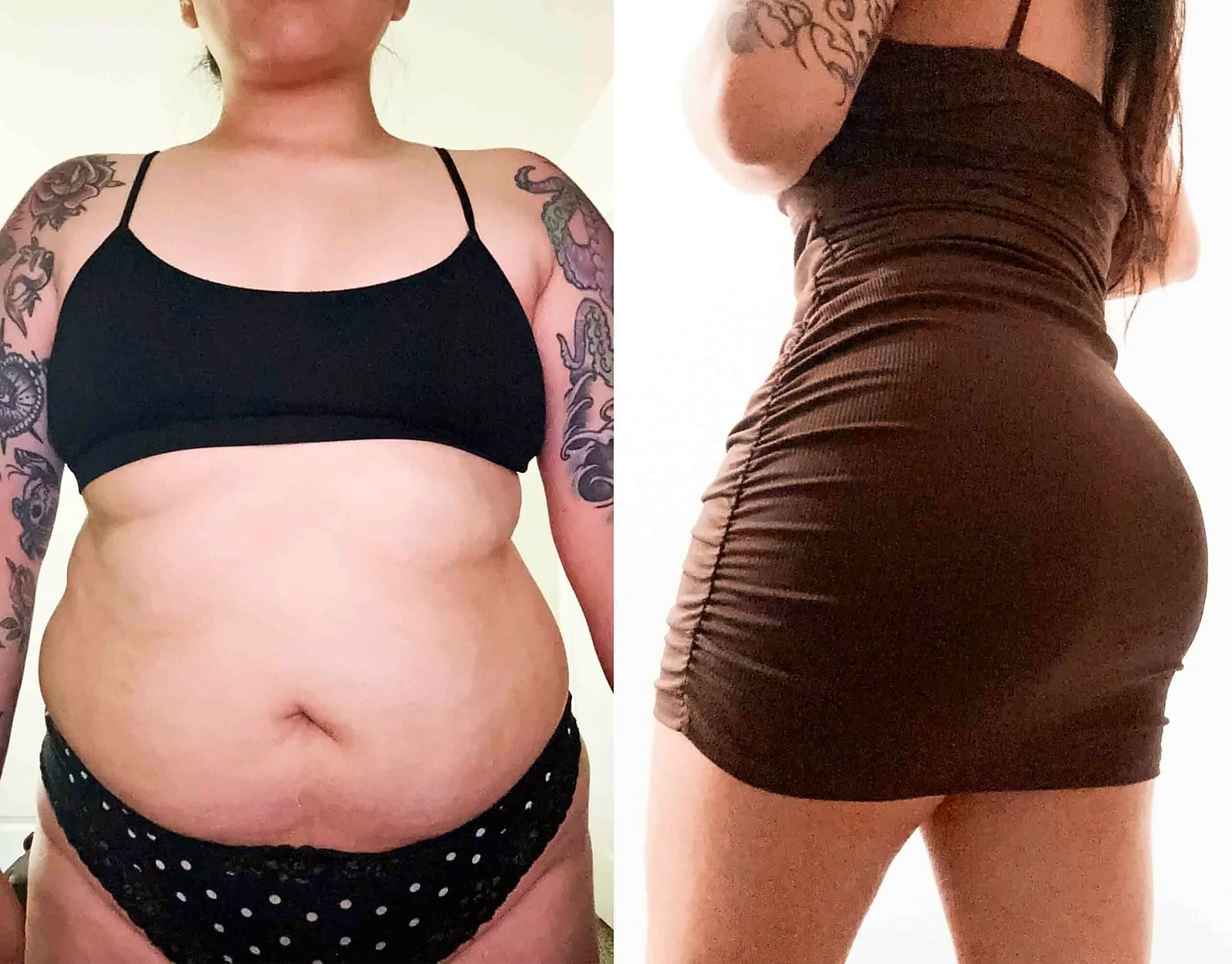 Fat Transfer, BBL before and after, actual patient of Dr. Long
